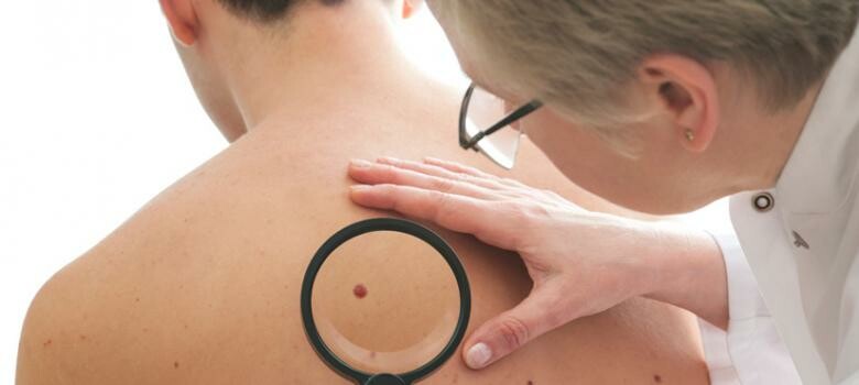 Early Detection of Melanoma