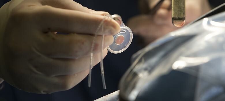 Acoustic Neuroma Technique Preserves, Restores Hearing