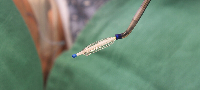 Balloon Offers Relief from Chronic Eustachian Tube Dysfunction