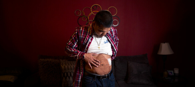 Duke Performs North Carolina’s First Abdominal Wall Transplant