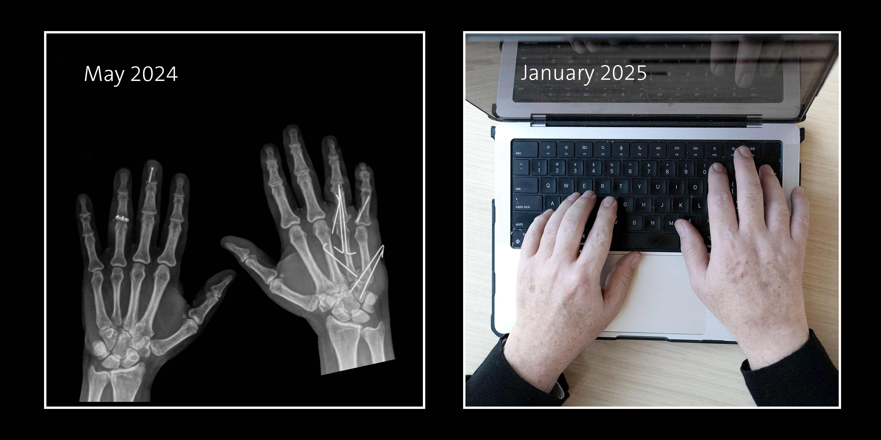 X-Rays of Mark's hands after surgery on the left. A photo of Mark's hands typing on a laptop months later.