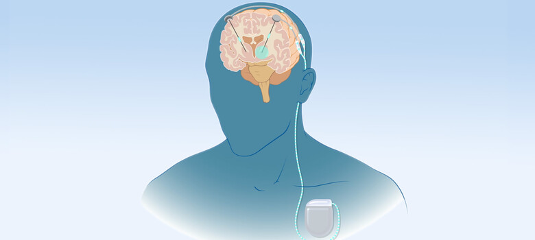 What You Need to Know About Deep Brain Stimulation for Movement Disorders