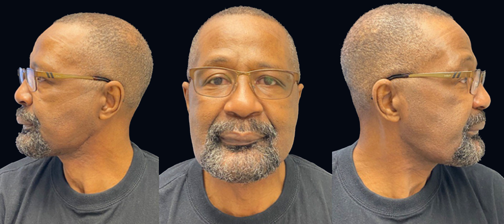 Roger Floyd six weeks after surgery. His incision was under his left jawline.