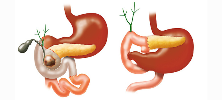 Whipple Surgery for Pancreatic Cancer